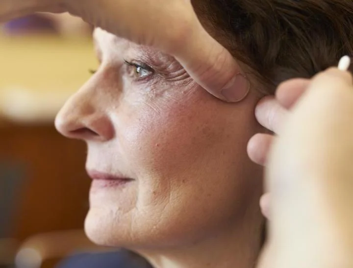 Planung der Schnittfuehrung fuer ein Mini-Facelift bei Dr. med. von Gregory in Berlin